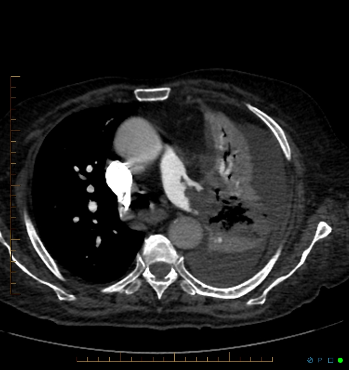 Cavitating pulmonary infarction (Radiopaedia 54634-60849 Axial C+ CTPA 26).jpg