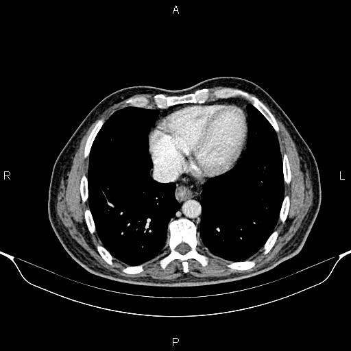 Cecal adenocarcinoma (Radiopaedia 85324-100916 B 5).jpg