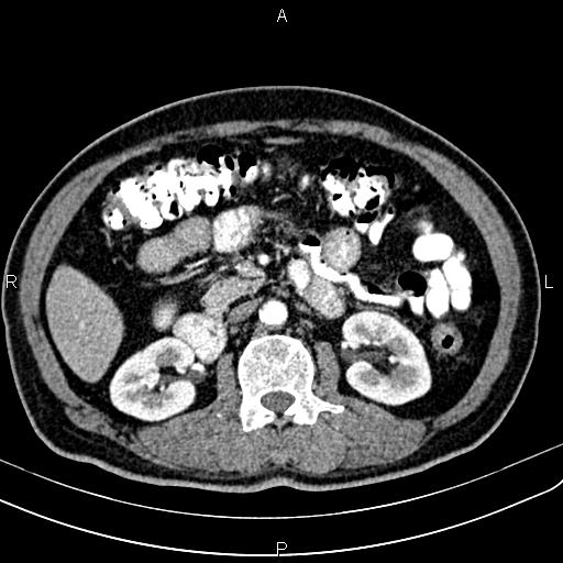 Cecal cancer with appendiceal mucocele (Radiopaedia 91080-108651 A 83).jpg