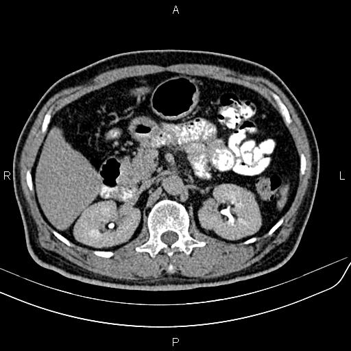 File:Cecal cancer with appendiceal mucocele (Radiopaedia 91080-108651 Axial C+ delayed 17).jpg