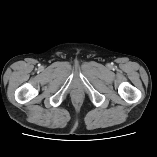 Cecal mass causing appendicitis (Radiopaedia 59207-66531 A 94).jpg