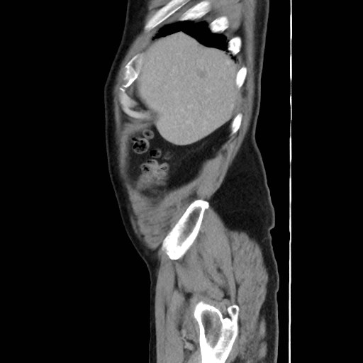 Cecal mass causing appendicitis (Radiopaedia 59207-66531 C 8).jpg