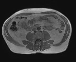 Cecal mass causing appendicitis (Radiopaedia 59207-66532 Axial T1 in-phase 78).jpg