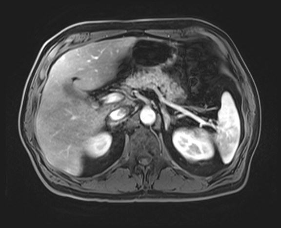 Cecal mass causing appendicitis (Radiopaedia 59207-66532 H 45).jpg