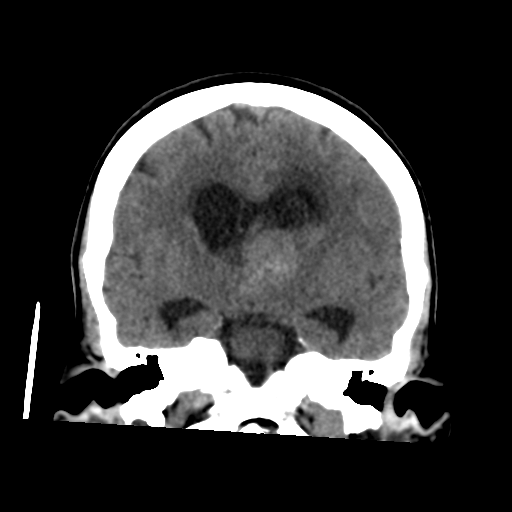 File:Central neurocytoma (Radiopaedia 65317-74346 Coronal non-contrast 30).png