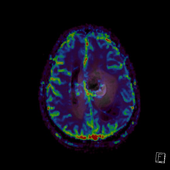 Central neurocytoma (Radiopaedia 84497-99872 Axial Perfusion 97).jpg