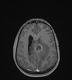 Central neurocytoma (Radiopaedia 84497-99872 Axial T1 C+ 106).jpg