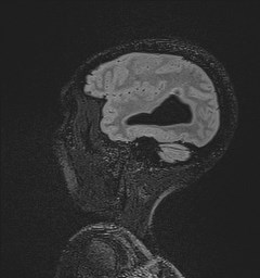 Central neurocytoma (Radiopaedia 84497-99872 Sagittal Flair + Gd 123).jpg