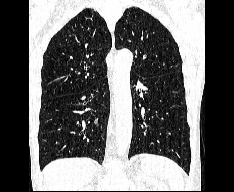 Centrilobular pulmonary emphysema (Radiopaedia 62468-70718 Coronal lung window 47).jpg