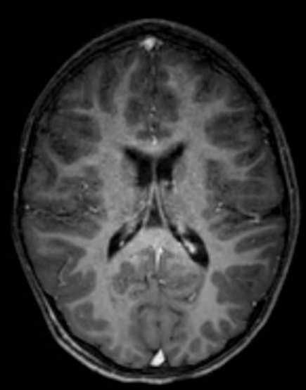 Cerebellar abscess (Radiopaedia 73727-84563 Axial T1 C+ fat sat 71).jpg