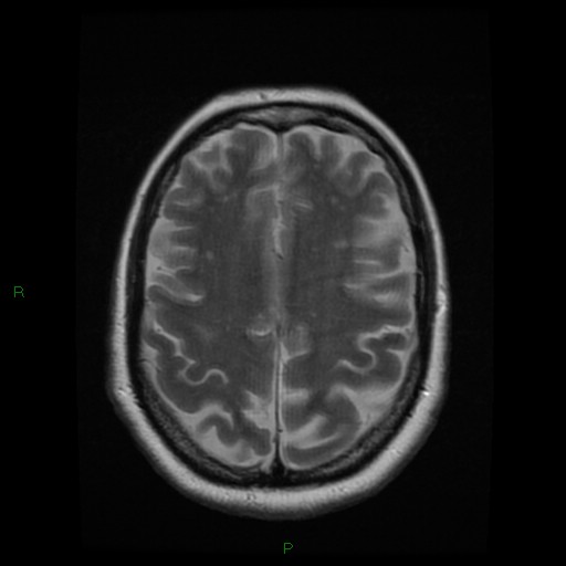 File:Cerebellar abscess (Radiopaedia 78135-90678 Axial T2 22).jpg