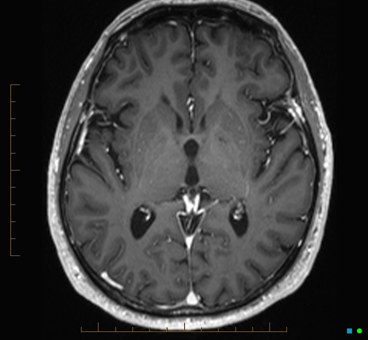 Cerebellar gangliocytoma (Radiopaedia 65377-74422 Axial T1 C+ 65).jpg