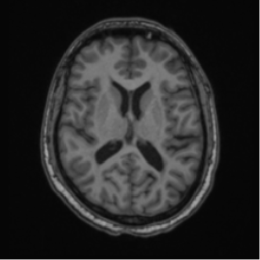 Cerebellar hemangioblastomas and pituitary adenoma (Radiopaedia 85490-101176 Axial T1 42).png
