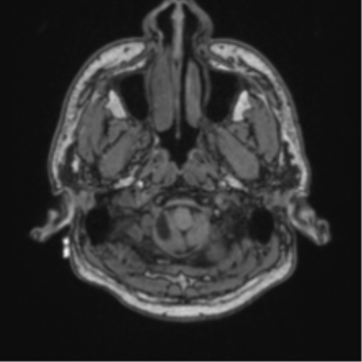 Cerebellar hemangioblastomas and pituitary adenoma (Radiopaedia 85490-101176 Axial T1 7).png
