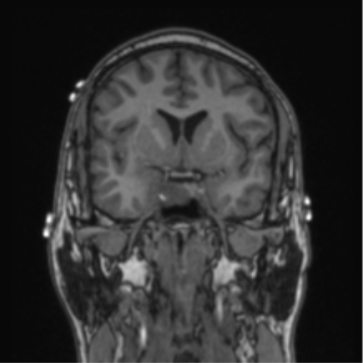Cerebellar hemangioblastomas and pituitary adenoma (Radiopaedia 85490-101176 Coronal T1 57).png
