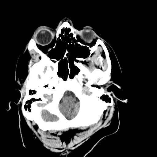 File:Cerebellar infarct due to vertebral artery dissection with posterior fossa decompression (Radiopaedia 82779-97029 Axial non-contrast 3).png