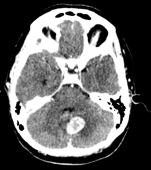 Cerebellar metastases - colorectal adenocarcinoma (Radiopaedia 40947-43652 Axial C+ 15).png