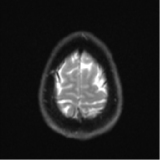 Cerebellar metastasis - adenocarcinoma lung (Radiopaedia 63184-71715 Axial DWI 27).png