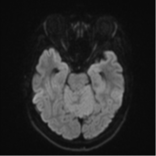 Cerebellar metastasis - adenocarcinoma lung (Radiopaedia 63184-71715 Axial DWI 39).png