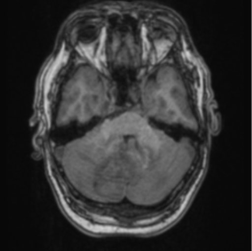 Cerebellar metastasis from lung adenocarcinoma (Radiopaedia 86690-102829 Axial T1 25).png