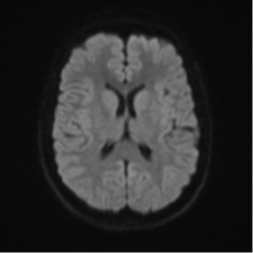 Cerebellar tuberculomas (Radiopaedia 46939-51472 Axial DWI 45).png
