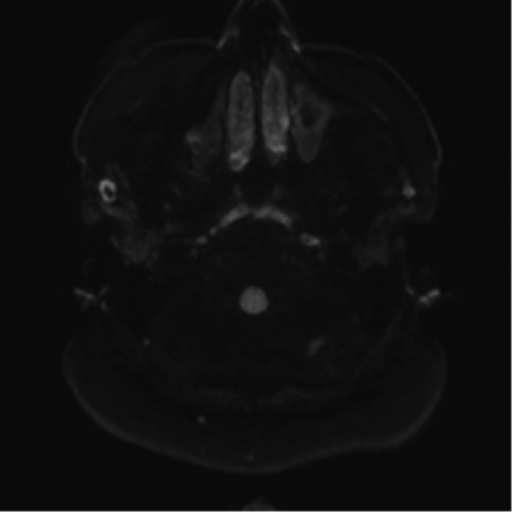 Cerebellopontine angle meningioma (Radiopaedia 48434-53348 Axial DWI 37).png