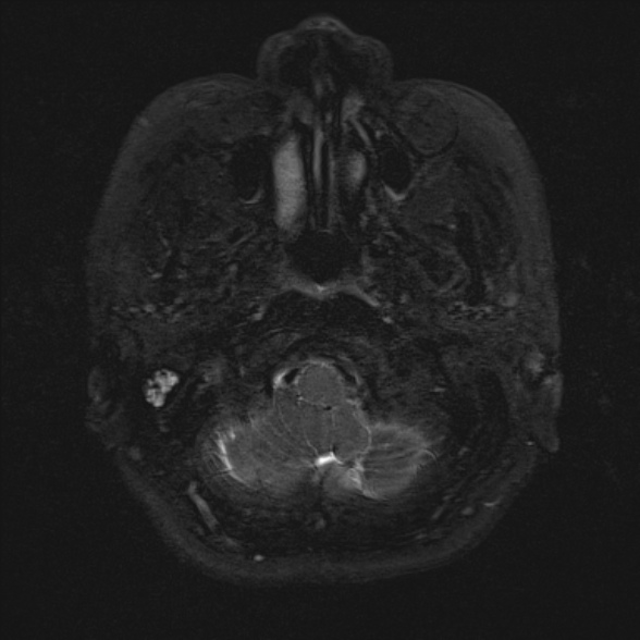 Cerebellopontine angle meningioma (Radiopaedia 53561-59591 Axial 3D volume T2 10).jpg