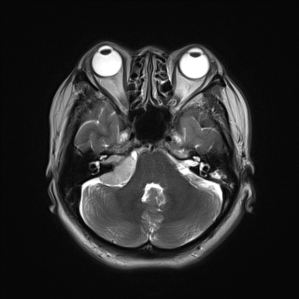 File:Cerebellopontine angle meningioma (Radiopaedia 53561-59591 Axial T2 7).jpg