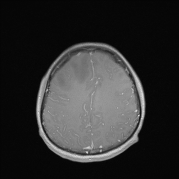 Cerebral abscess (Radiopaedia 24212-24478 Axial T1 C+ 45).jpg