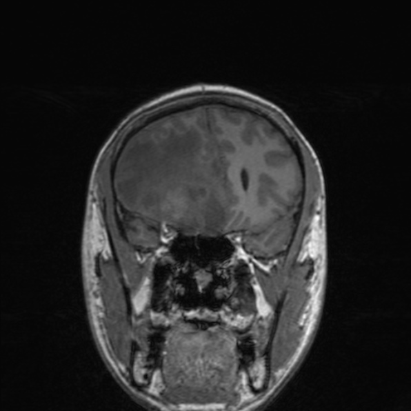 Cerebral abscess (Radiopaedia 24212-24478 Coronal T1 73).jpg