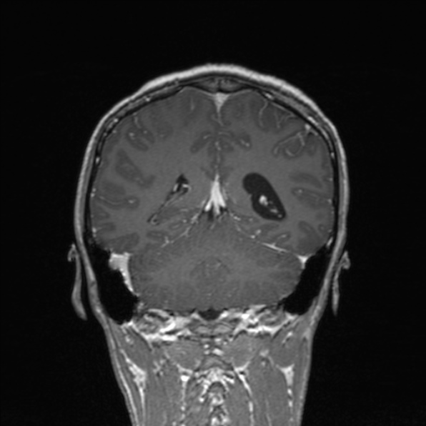 Cerebral abscess (Radiopaedia 24212-24478 Coronal T1 C+ 143).jpg