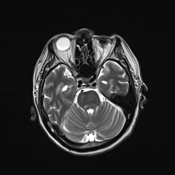 Cerebral abscess (Radiopaedia 26111-26247 Axial T2 23).jpg