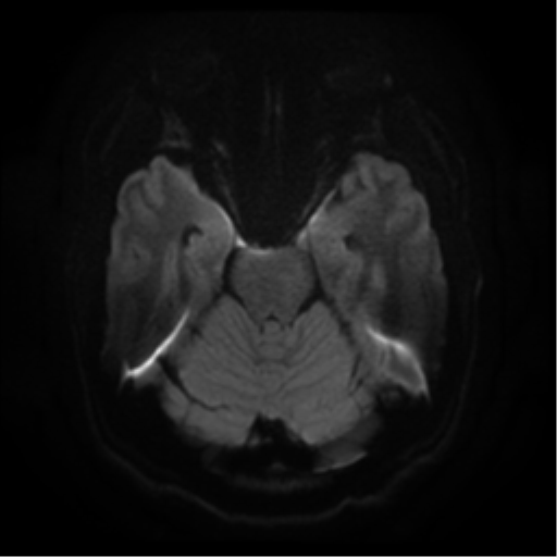 File:Cerebral abscess (Radiopaedia 57774-64740 Axial DWI 9).png