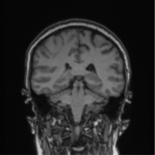 Cerebral abscess from pulmonary arteriovenous malformation (Radiopaedia 86275-102291 Coronal T1 37).png