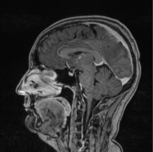 Cerebral abscess from pulmonary arteriovenous malformation (Radiopaedia 86275-102291 Sagittal T1 C+ 40).png