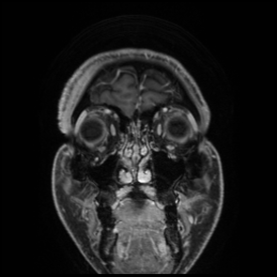 Cerebral abscess with ventriculitis (Radiopaedia 78965-91878 Coronal T1 C+ 11).jpg