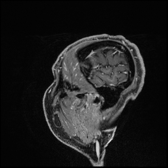 Cerebral abscess with ventriculitis (Radiopaedia 78965-91878 Sagittal T1 C+ 162).jpg