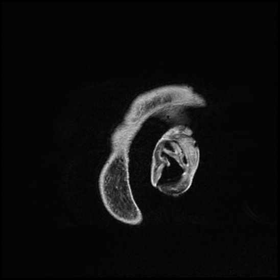 Cerebral abscess with ventriculitis (Radiopaedia 78965-91878 Sagittal T1 C+ 179).jpg
