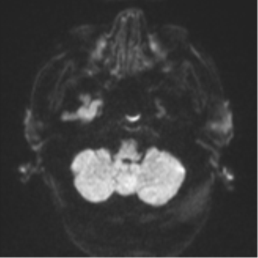 Cerebral abscesses- medically managed (Radiopaedia 45183-49179 Axial DWI 34).png
