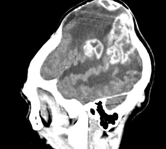 File:Cerebral abscesses (Radiopaedia 70458-80568 Sagittal Contrast 13).jpg