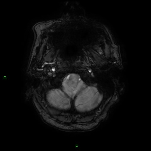 File:Cerebral amyloid angiopathy-associated lobar intracerebral hemorrhage (Radiopaedia 58376-65512 Axial SWI 4).jpg
