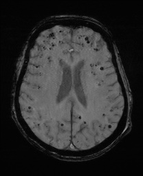 File:Cerebral amyloid angiopathy-related inflammation (Radiopaedia 74836-85849 Axial SWI 45).jpg