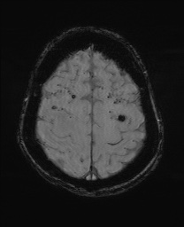 File:Cerebral amyloid angiopathy-related inflammation (Radiopaedia 74836-85849 Axial SWI 57).jpg