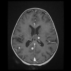 Cerebral and spinal tuberculosis (Radiopaedia 90489-107837 Axial T1 C+ 119).jpg