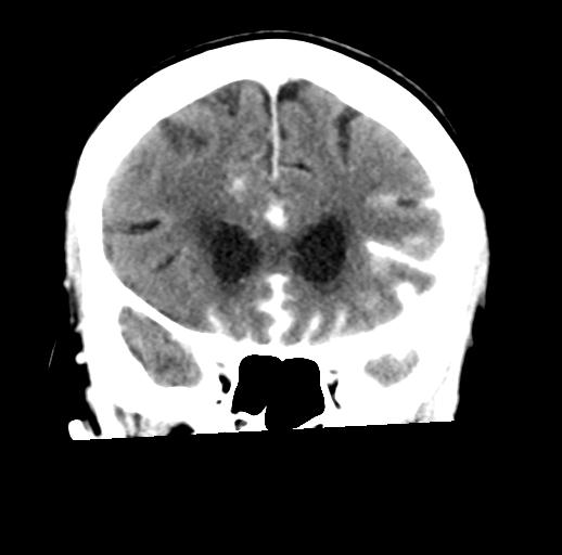 File:Cerebral aneurysm with rupture (Radiopaedia 29933-30460 Coronal non-contrast 12).jpg