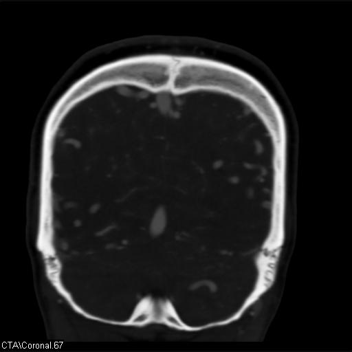 Cerebral arteriovenous malformation (Radiopaedia 28518-28759 C 67).jpg