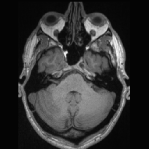 Cerebral arteriovenous malformation (Radiopaedia 55798-62372 Axial T1 13).png