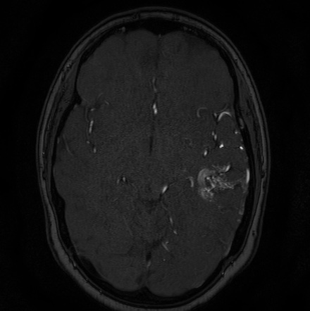 Cerebral arteriovenous malformation (Radiopaedia 74411-85654 Axial MRA 60).jpg