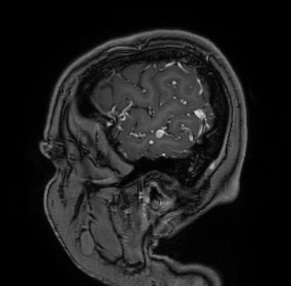 Cerebral arteriovenous malformation (Radiopaedia 74411-85654 Sagittal T1 C+ 10).jpg