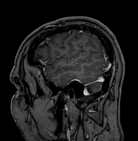Cerebral arteriovenous malformation (Radiopaedia 74411-85746 Sagittal T1 C+ 14).jpg